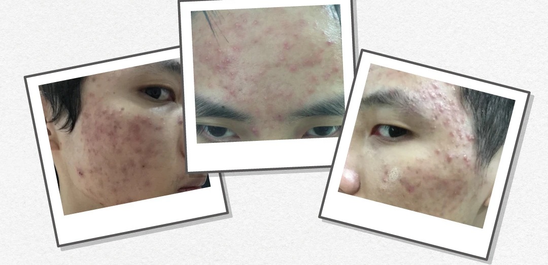 Alan 8 年前的真實照片 — 滿臉痘痘的那些年